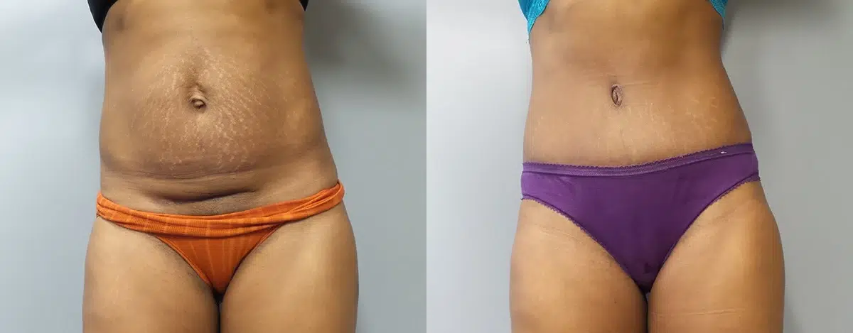 tummy tuck abdominoplasty before and after photo by main line institute of plastic surgery in wynnewood pa