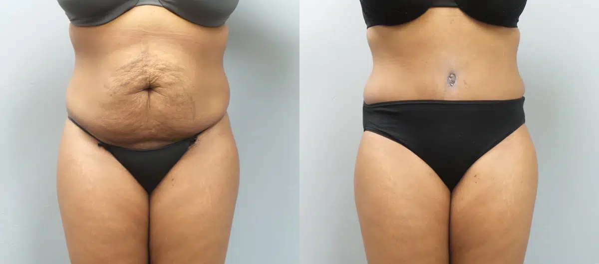 tummy tuck abdominoplasty before and after photo by main line institute of plastic surgery in wynnewood pa