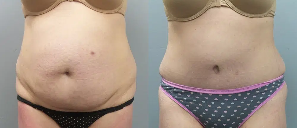 tummy tuck abdominoplasty before and after photo by main line institute of plastic surgery in wynnewood pa