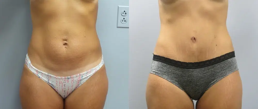 tummy tuck abdominoplasty before and after photo by main line institute of plastic surgery in wynnewood pa