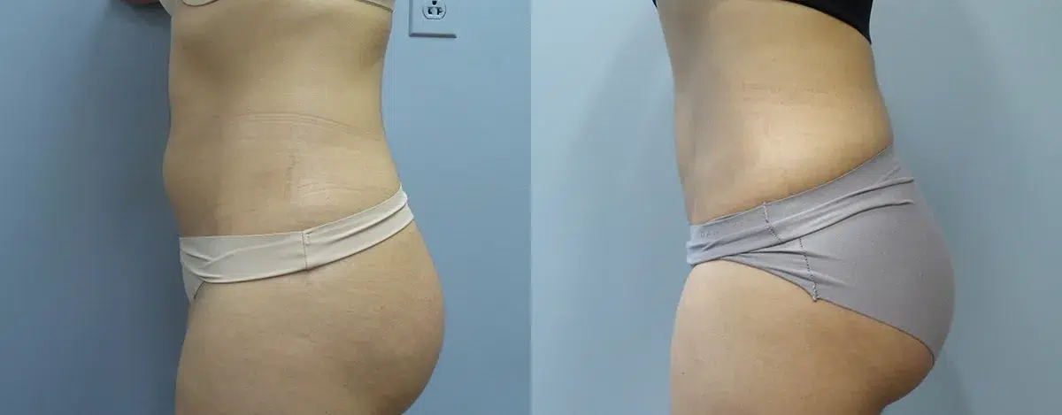 liposuction before and after photo by main line institute of plastic surgery in wynnewood pa