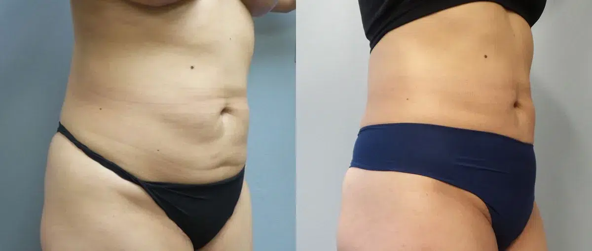 liposuction before and after photo by main line institute of plastic surgery in wynnewood pa