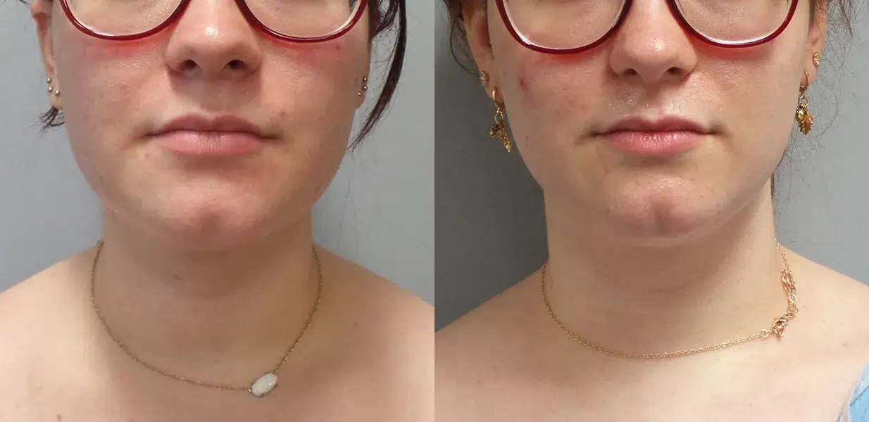 liposuction before and after photo by main line institute of plastic surgery in wynnewood pa