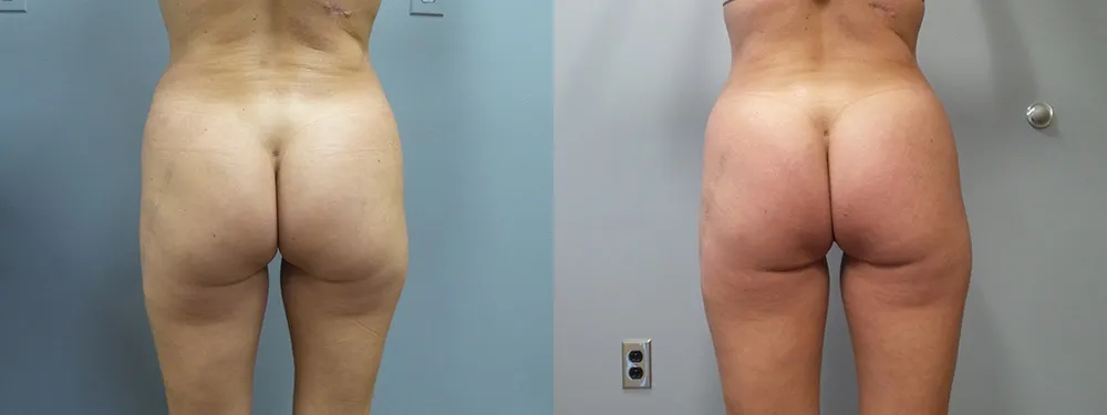 brazilian butt lift before and after photo by main line institute of plastic surgery in wynnewood pa