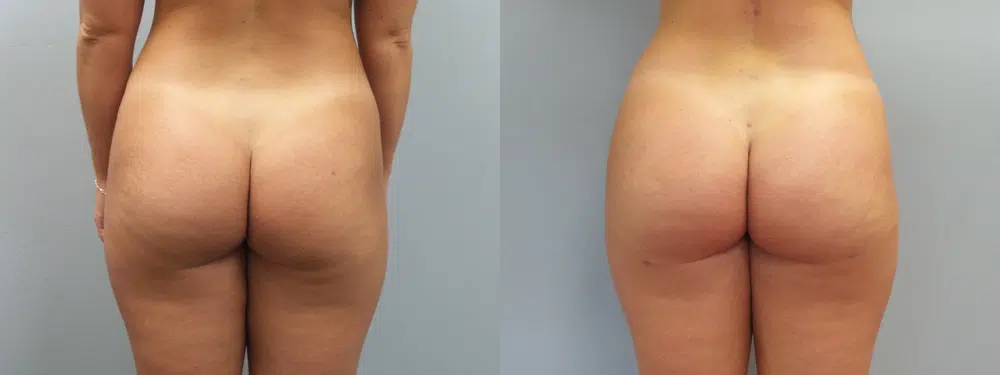 brazilian butt lift before and after photo by main line institute of plastic surgery in wynnewood pa