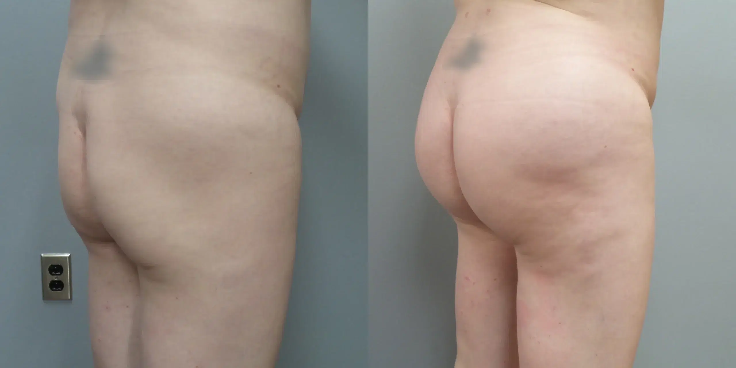 brazilian butt lift before and after photo by main line institute of plastic surgery in wynnewood pa