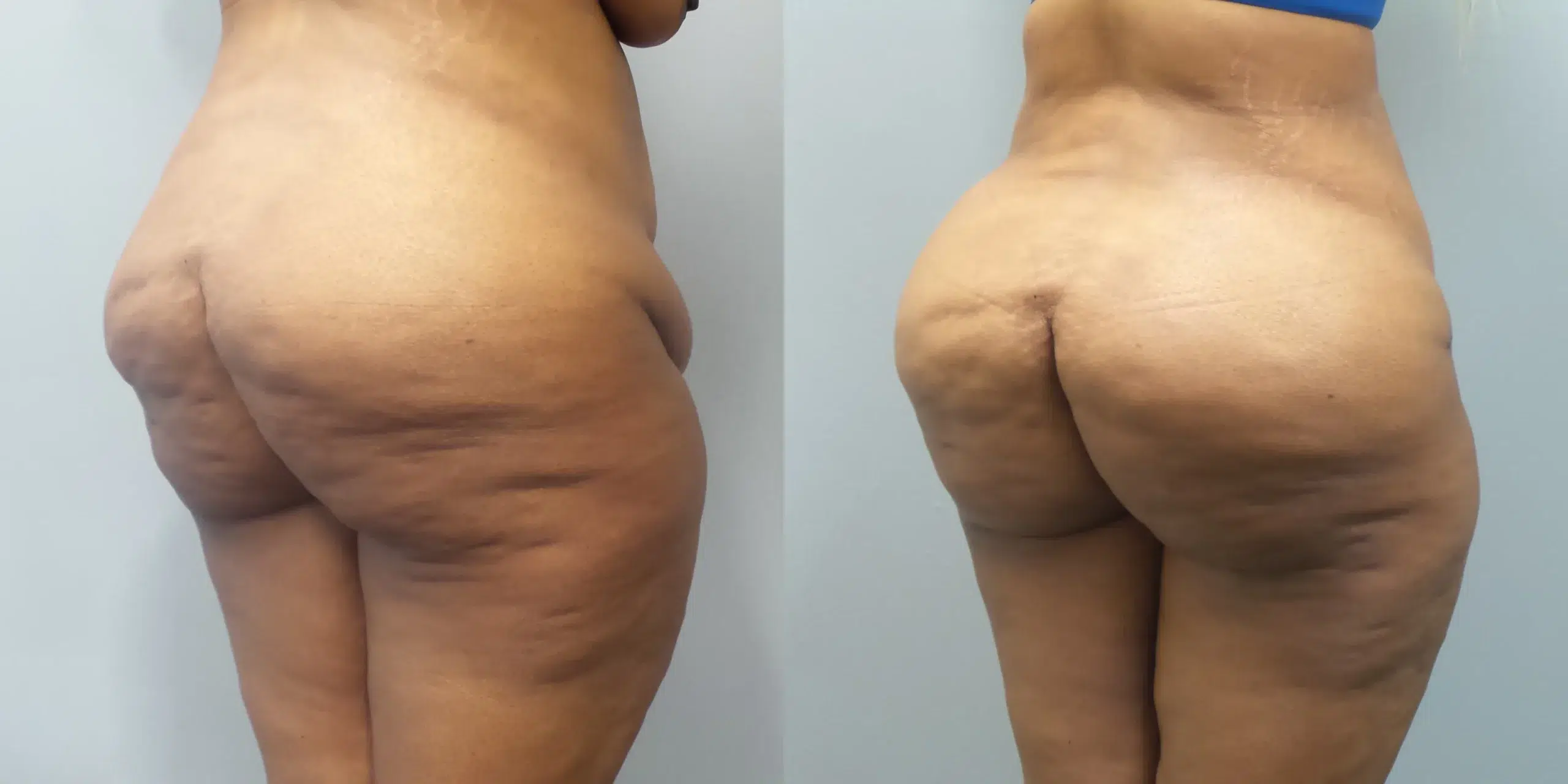 brazilian butt lift before and after photo by main line institute of plastic surgery in wynnewood pa