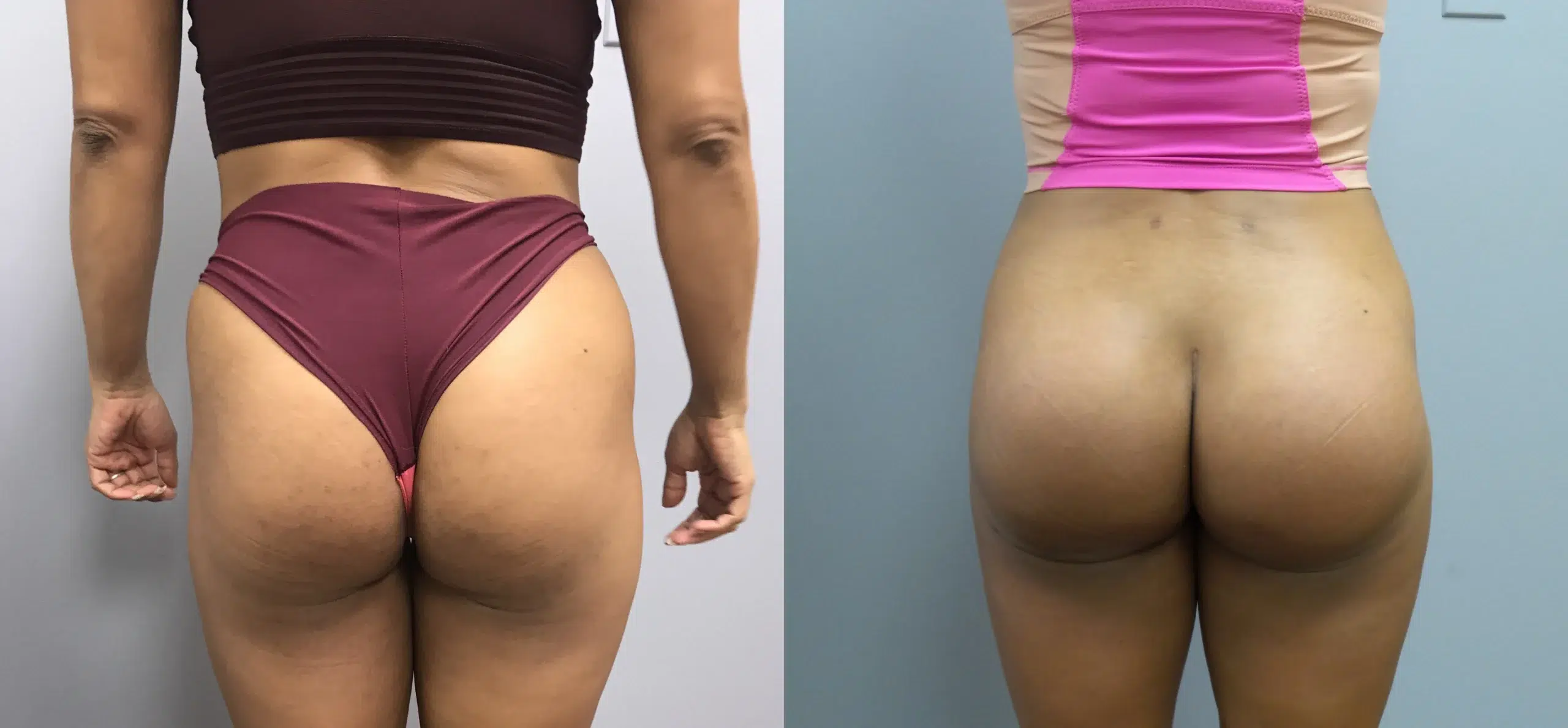 butt implants before and after photo by main line institute of plastic surgery in wynnewood pa
