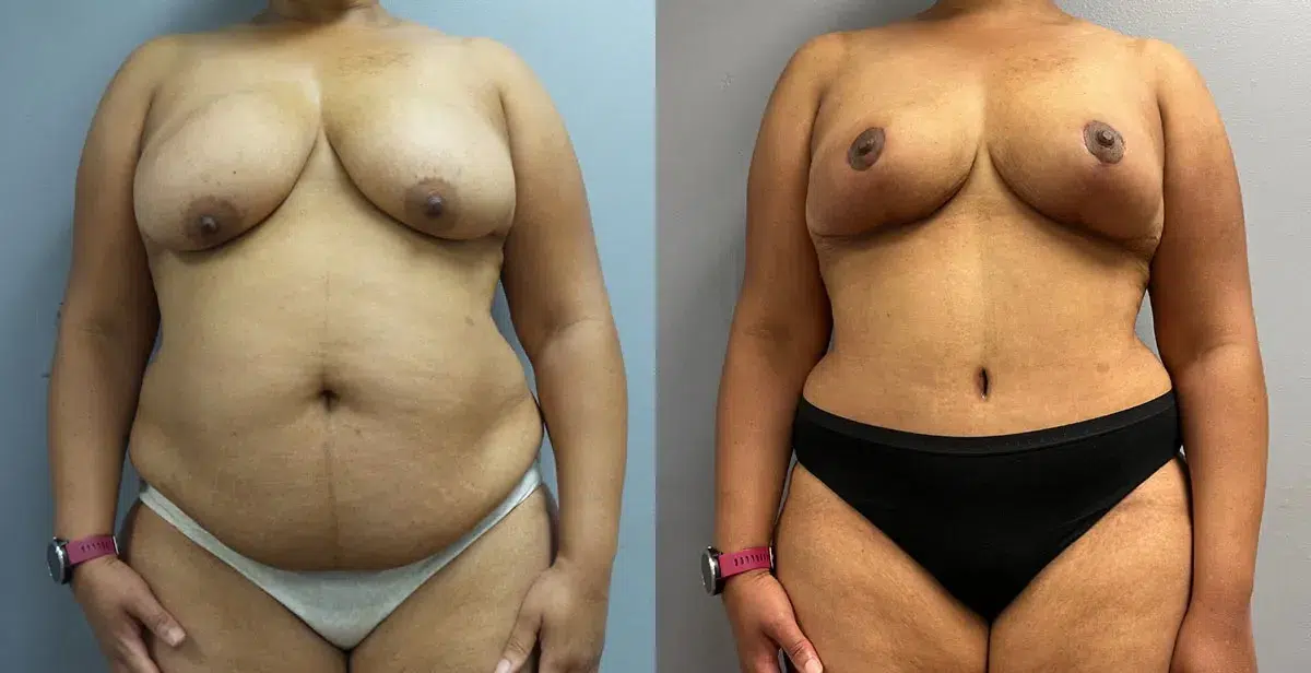 mommy makeover before and after photo by main line institute of plastic surgery in wynnewood pa