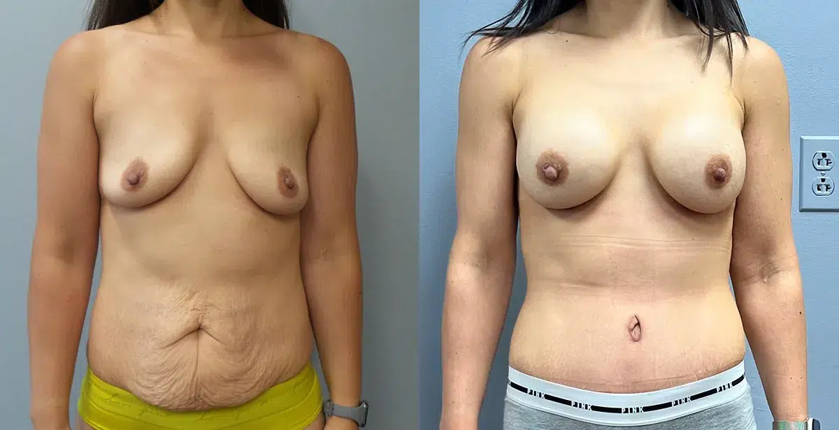 mommy makeover before and after photo by main line institute of plastic surgery in wynnewood pa