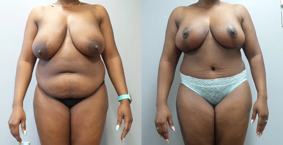 mommy makeover before and after photo by main line institute of plastic surgery in wynnewood pa