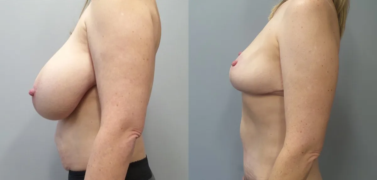 mommy makeover before and after photo by main line institute of plastic surgery in wynnewood pa