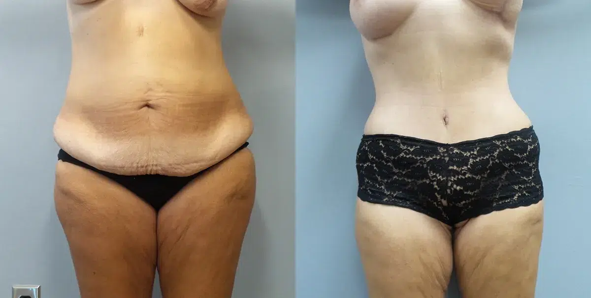 mommy makeover before and after photo by main line institute of plastic surgery in wynnewood pa
