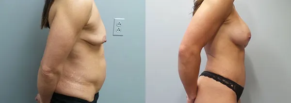 mommy makeover before and after photo by main line institute of plastic surgery in wynnewood pa