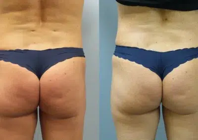 beautifill before and after photo by main line institute of plastic surgery in wynnewood pa beautifill before and after photo by main line institute of plastic surgery in wynnewood pa