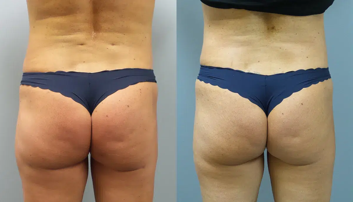 beautifill before and after photo by main line institute of plastic surgery in wynnewood pa