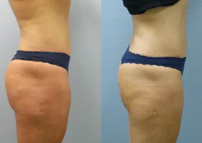 beautifill before and after photo by main line institute of plastic surgery in wynnewood pa beautifill before and after photo by main line institute of plastic surgery in wynnewood pa