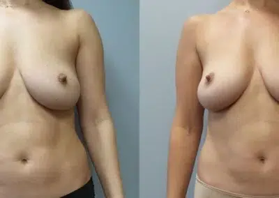 beautifill before and after photo by main line institute of plastic surgery in wynnewood pa beautifill before and after photo by main line institute of plastic surgery in wynnewood pa