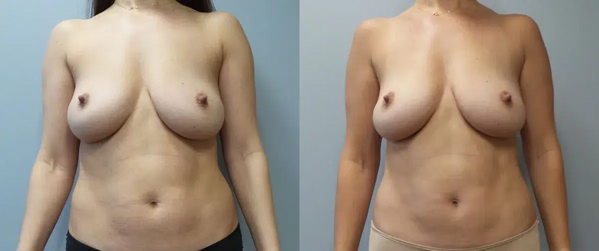 beautifill before and after photo by main line institute of plastic surgery in wynnewood pa