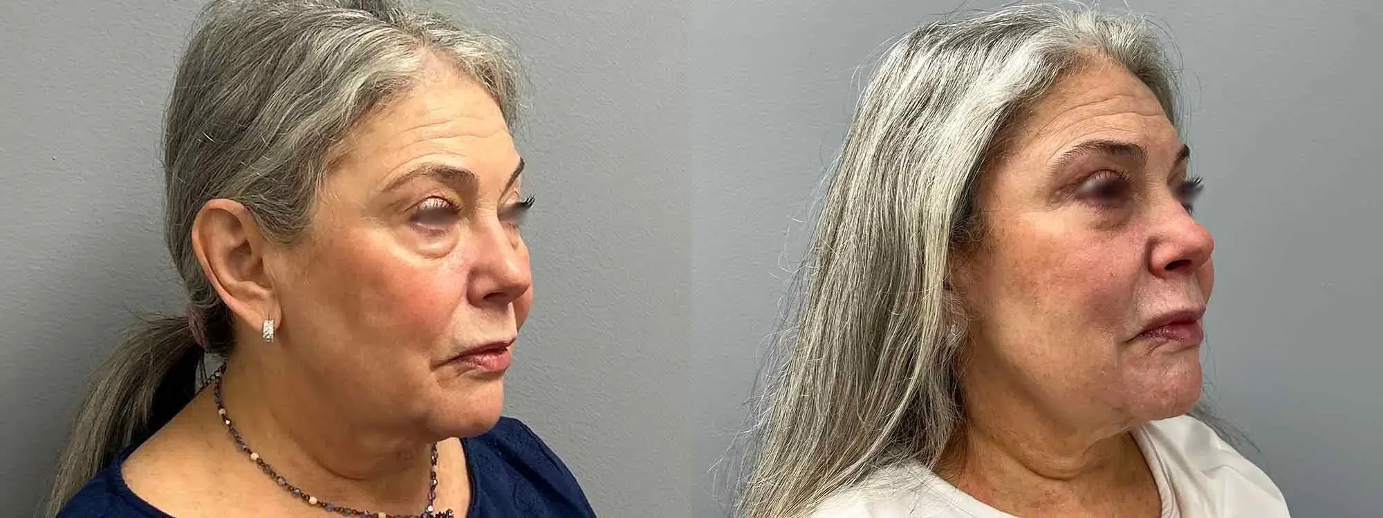 blepharoplasty before and after photo by main line institute of plastic surgery in wynnewood pa