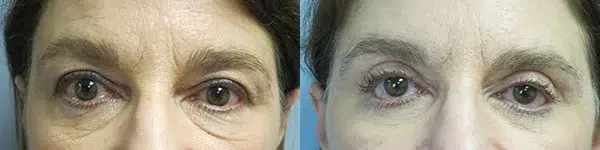 blepharoplasty before and after photo by main line institute of plastic surgery in wynnewood pa