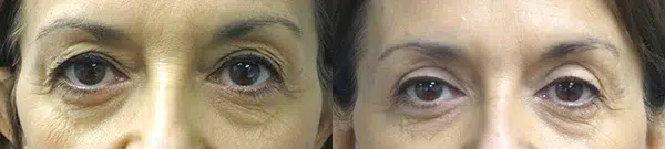 blepharoplasty before and after photo by main line institute of plastic surgery in wynnewood pa
