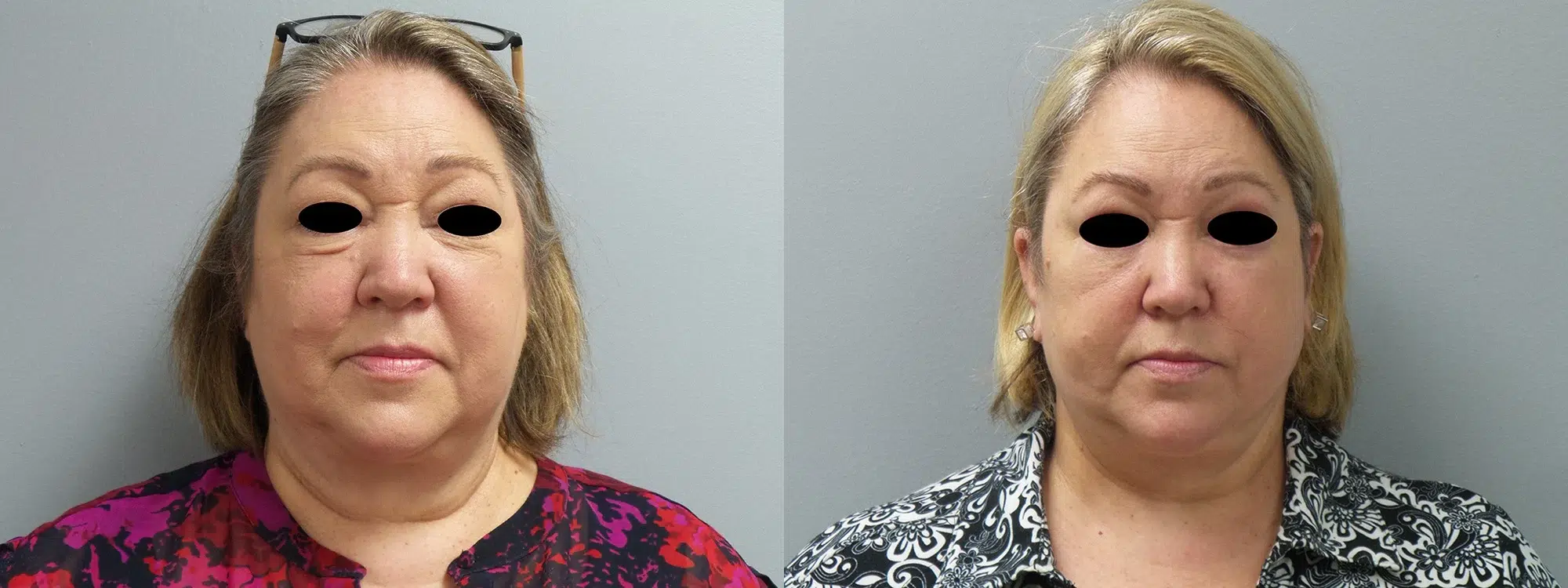 blepharoplasty before and after photo by main line institute of plastic surgery in wynnewood pa
