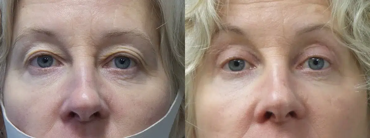 blepharoplasty before and after photo by main line institute of plastic surgery in wynnewood pa
