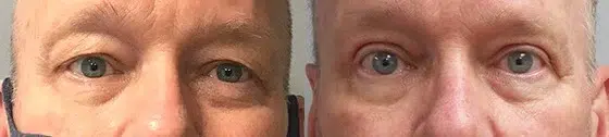 blepharoplasty before and after photo by main line institute of plastic surgery in wynnewood pa