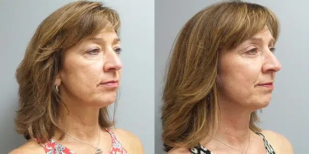 blepharoplasty before and after photo by main line institute of plastic surgery in wynnewood pa
