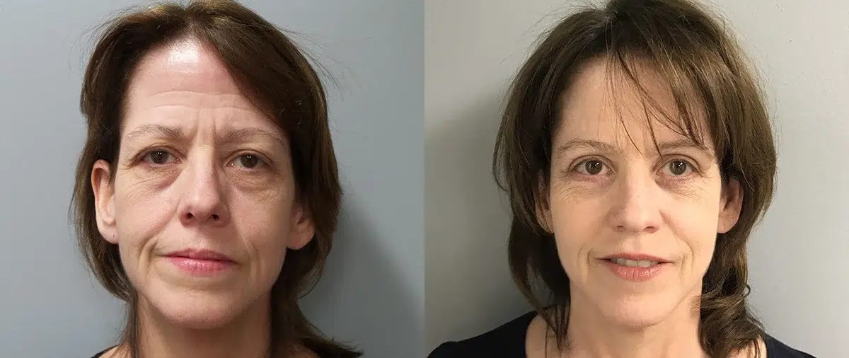 blepharoplasty before and after photo by main line institute of plastic surgery in wynnewood pa