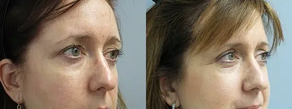 blepharoplasty before and after photo by main line institute of plastic surgery in wynnewood pa