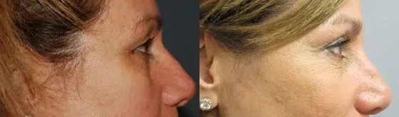 blepharoplasty before and after photo by main line institute of plastic surgery in wynnewood pa