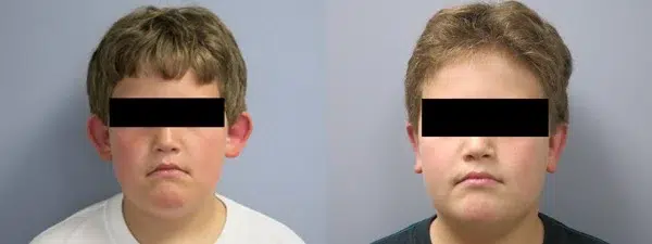 otoplasty before and after photo by main line institute of plastic surgery in wynnewood pa