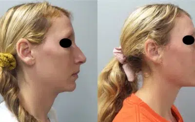 rhinoplasty before and after photo by main line institute of plastic surgery in wynnewood pa rhinoplasty before and after photo by main line institute of plastic surgery in wynnewood pa