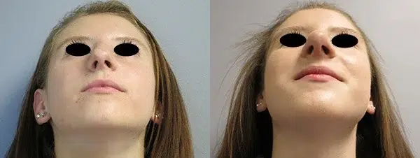 rhinoplasty before and after photo by main line institute of plastic surgery in wynnewood pa