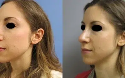 rhinoplasty before and after photo by main line institute of plastic surgery in wynnewood pa rhinoplasty before and after photo by main line institute of plastic surgery in wynnewood pa