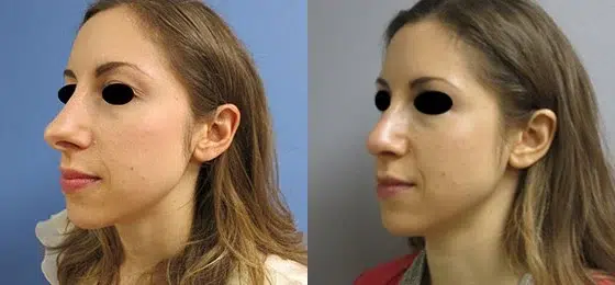 rhinoplasty before and after photo by main line institute of plastic surgery in wynnewood pa