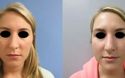 rhinoplasty before and after photo by main line institute of plastic surgery in wynnewood pa rhinoplasty before and after photo by main line institute of plastic surgery in wynnewood pa