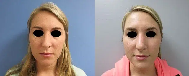 rhinoplasty before and after photo by main line institute of plastic surgery in wynnewood pa