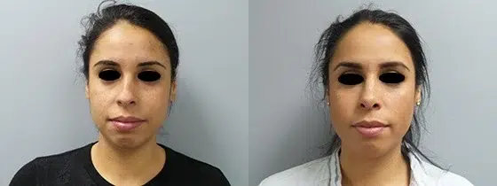 rhinoplasty before and after photo by main line institute of plastic surgery in wynnewood pa