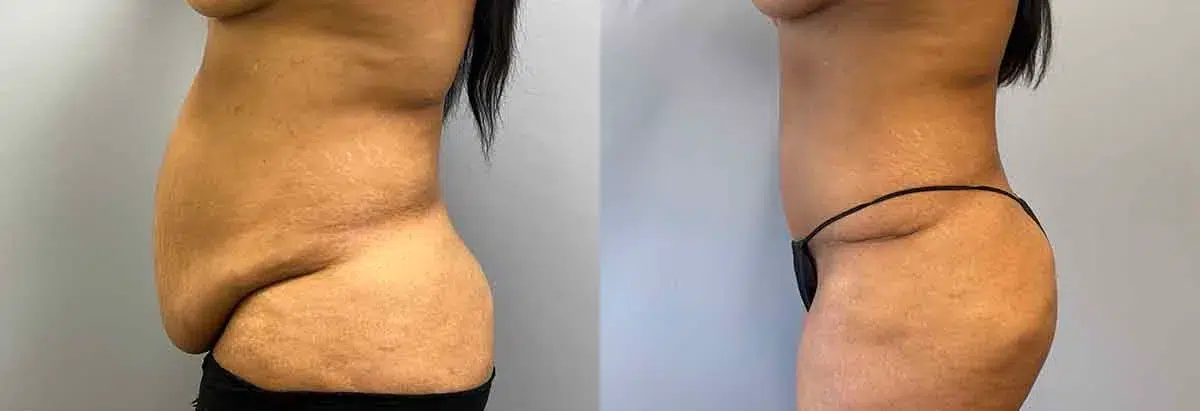 tummy tuck abdominoplasty before and after photo by main line institute of plastic surgery in wynnewood pa