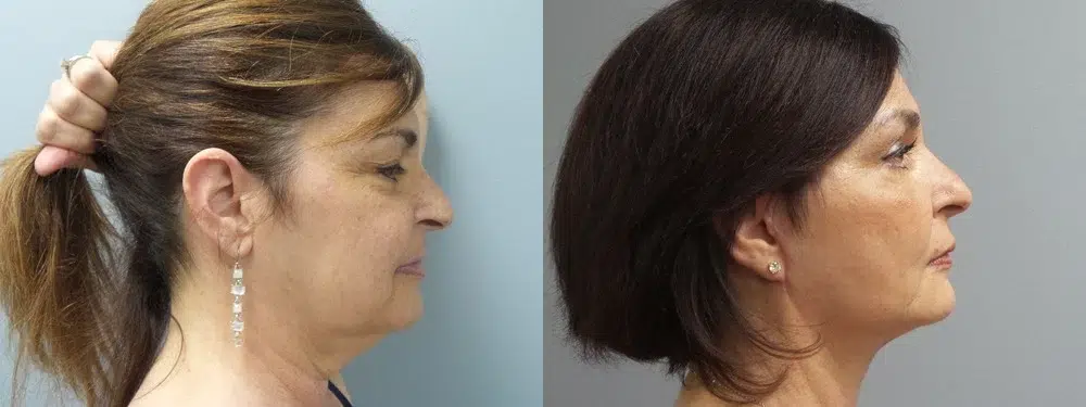 facelift before and after photo by main line institute of plastic surgery in wynnewood pa