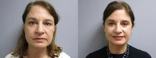 facelift before and after photo by main line institute of plastic surgery in wynnewood pa