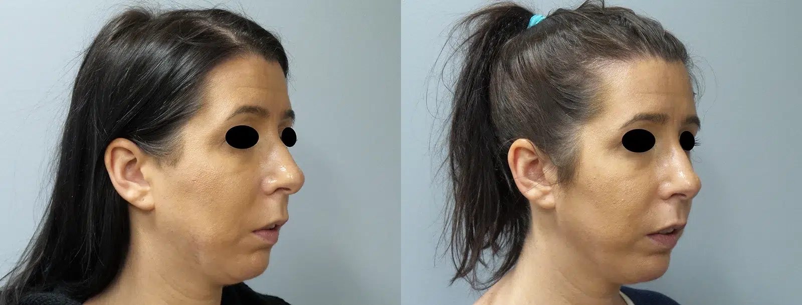 fat grafting before and after photo by main line institute of plastic surgery in wynnewood pa