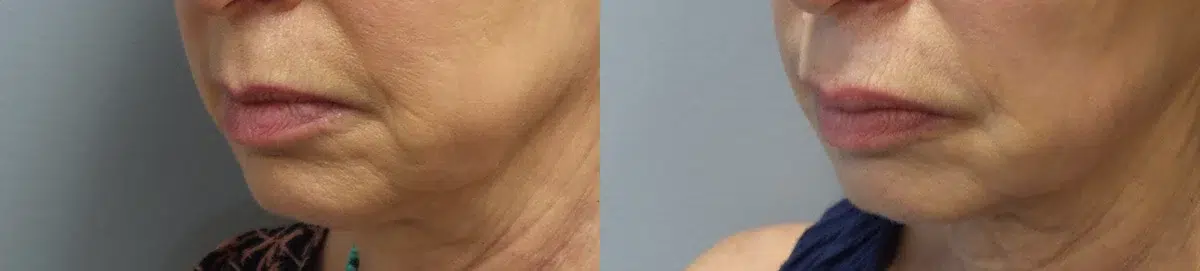 facial fillers before and after photo by main line institute of plastic surgery in wynnewood pa