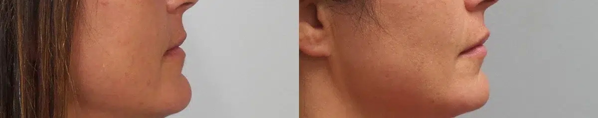 facial fillers before and after photo by main line institute of plastic surgery in wynnewood pa