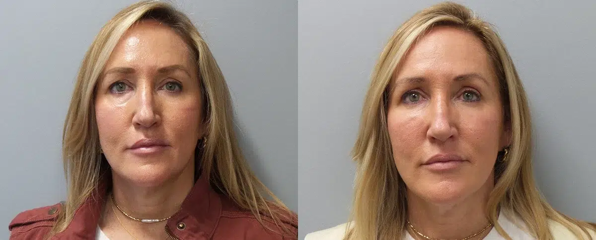 facial fillers before and after photo by main line institute of plastic surgery in wynnewood pa