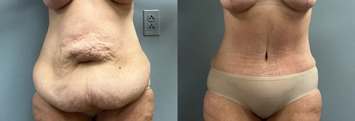 tummy tuck abdominoplasty before and after photo by main line institute of plastic surgery in wynnewood pa