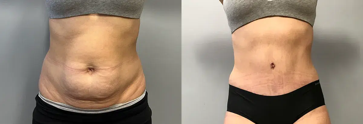 tummy tuck abdominoplasty before and after photo by main line institute of plastic surgery in wynnewood pa